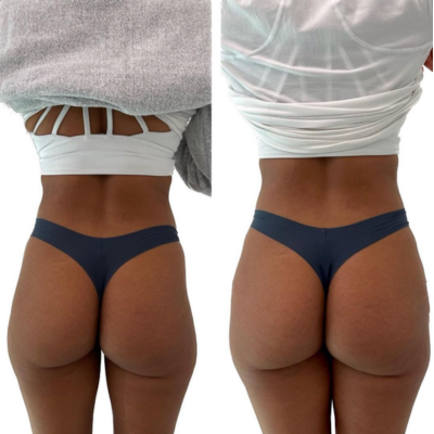 Non Surgical BBL