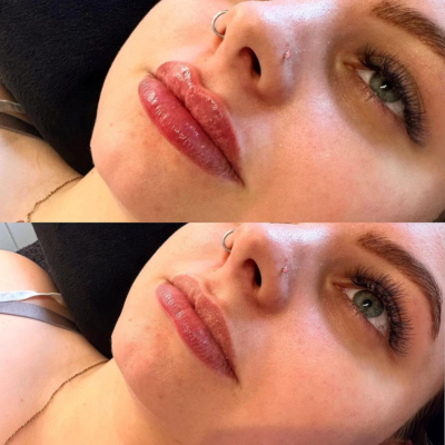 Lip Augmentation: 1 Syringe Stylage