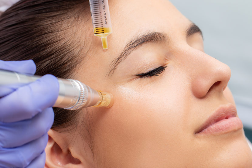 Blue Cosmetic Clinic, Microneedling Treatment in Richmond Hill