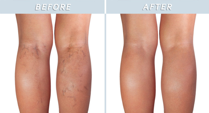 Blue Cosmetic Clinic, Spider Vein Removal in Richmond Hill